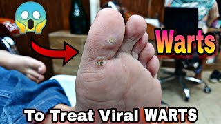 Warts To Treat Viral infection Treatment  Footcare33 [upl. by Ijneb]