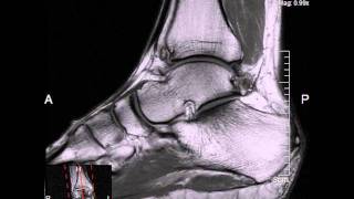 MRI on my ankle [upl. by Sharp]