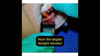 Extraction of Three Teeth with Sectioning Using Bien Air Handpiece [upl. by Sidnee]