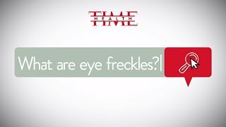 What Are Eye Freckles  Health [upl. by Irak]