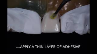 Porcelain Veneer Cementation step by step technique [upl. by Mame599]