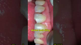 Fix broken tooth filling dentist dentisty tooth [upl. by Coombs]