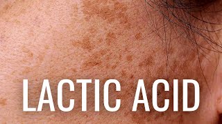 WHY Lactic Acid is Best For Hyperpigmentation [upl. by Antipas]