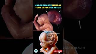 Dont Miss This Nutrient 👉 Folic Acid in Pregnancy  Neural Tube Defects shortsfeed pregnancy baby [upl. by Mercie636]