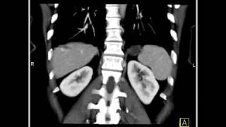 Abdomen Liver Hemangioma of the Liver7 of 8 [upl. by Notffilc958]