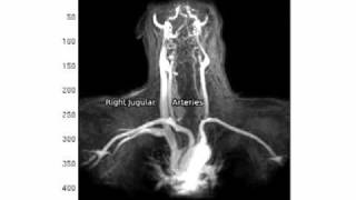 UBC Time Resolved MRI VenographyAngiography in MS [upl. by Adnohsirk]