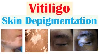 Vitiligo Skin Depigmentation  Pathophysiology Signs and Symptoms Diagnosis Treatment [upl. by Mitchiner]