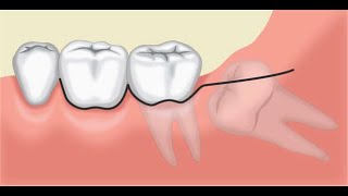 Auto Transplantation – A Viable Option of Saving Teeth [upl. by Vance296]