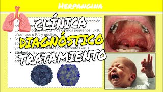 ⚕️🩺 HERPANGINA Infecciones Respiratorias Agudas Síntomas Diagnóstico y Tratamiento [upl. by Weiman142]