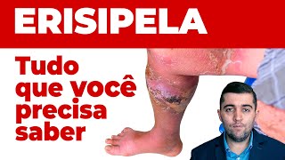 Erispela como curar sinais e sintomas e como prevenir suas complicações Guia completo da doença [upl. by Attelrahs]