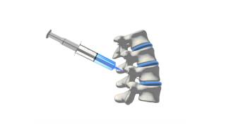 Medial Branch Block [upl. by Essam445]