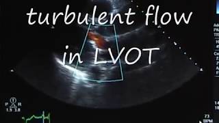 Systolic Anterior MotionSAM following Mitral Valve Prolapse Repair [upl. by Gerrit788]