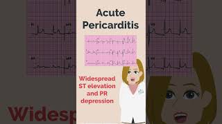 Acute Pericarditis and Myocardial Infarction  PLAB  UKMLA  MedRevisions [upl. by Shaine177]