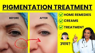 Pigmentation Treatment At Home  Causes Treatment Prevention [upl. by Einaej330]