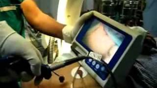 Glidescope intubation [upl. by Lachish528]