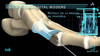 Technique opératoire Hallux valgus [upl. by Belak]