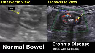 Small Bowel Ultrasound Normal Vs Abnormal Image Appearances  Gastrointestinal Tract GIT USG [upl. by Alidus114]