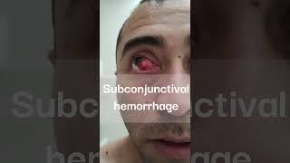 Subconjunctival hemorrhage ophthalmology hemorrhage health [upl. by Adnanref]