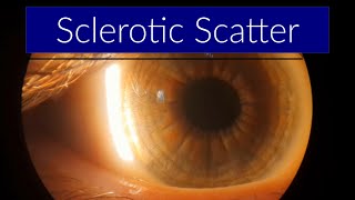 Sclerotic Scatter  Slit Lamp Techniques [upl. by Ailak]