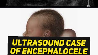 Encephalocele or Cystic Hygroma  Learn ultrasound [upl. by Hermes692]