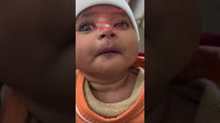 Laryngomalacia No Treatment Then Supraglottoplasty [upl. by Ymmaj]