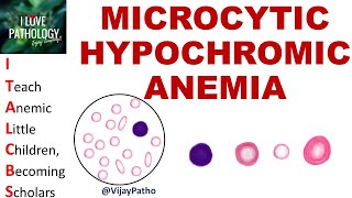 MICROCYTIC HYPOCHROMIC ANEMIA Causes Mechanism amp Approach [upl. by Amlev]