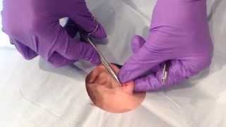 Cyst Excision  Surgical excision of a cyst on the earlobe [upl. by Ahsonek]