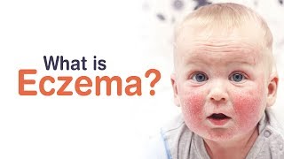 What is Eczema  ECZEMA IN BABIES  CHILDCARE  SKIN CARE [upl. by Manville]