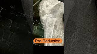 Close reduction of proximal epiphyseal slip of tibia in kids  SALTERHARRIS type 1 [upl. by Vullo]