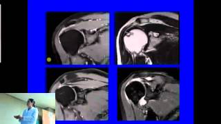 Resonancia Magnética Nuclear en Hombro [upl. by Phyllida469]