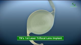 1st Laser Trifocal Lens Implant in Tennessee [upl. by Fretwell]