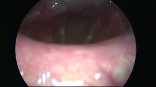 Vocal cord nodules in tele Laryngoscopy 90 degree without any topical spray anesthesia [upl. by Filler]