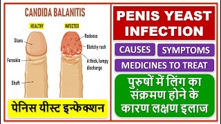 PENIS YEAST INFECTION TREATMENT पेनिस यीस्ट इन्फेक्शन लिंग का संक्रमण होने के कारण लक्षण इलाज [upl. by Guinevere]