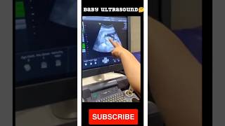 pregnancy ultrasound 25 weeks baby movements🥰🥰🥰viral trending [upl. by Nnadroj]