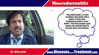 Neurodermatitis  Causes Diagnosis Symptoms Treatment Prognosis [upl. by Janeen998]