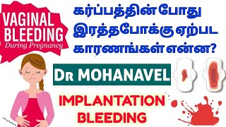 கர்ப்பகால இரத்தபோக்கு Bleeding During Pregnancy Causes TreatmentTamil Dr MOHANAVEL [upl. by Nylarej409]