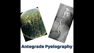 antegrade Pyelography [upl. by Marfe]