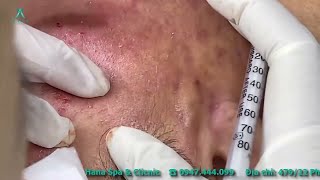 Big Cystic Acne Blackheads Extraction Blackheads amp Milia Whiteheads Removal Pimple Popping [upl. by Bloomer]