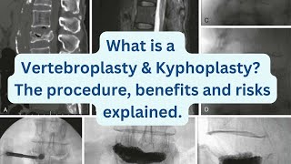 What is a Vertebroplasty amp Kyphoplasty The procedure benefits and risks explained [upl. by Amilah]