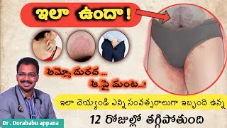 HOW TO GET RID SKIN PROBLEM AT GROIN REGION  skin treatment fungal infection dr dorababu appana [upl. by Evot]