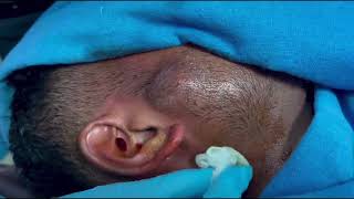 FACE ABSCESS  An immediate improvement after pus aspiration  Needle aspiration [upl. by Acirtap]