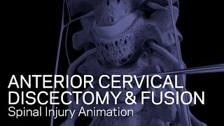 C56C67 Anterior Cervical Discectomy with Fusion [upl. by Craggy]