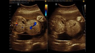 Omphalocele and Bilobed Placenta [upl. by Nicholson]