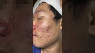 HHV Clinic  dothuhien  Mụn mủ quanh mũi [upl. by Luwana]