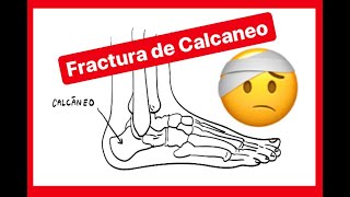 FRACTURA DE CALCANEO 🤕 Y SU CLASIFICACION Dr Arkel explica [upl. by Itsym913]