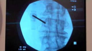 Compression Fracture Watch a Balloon Assisted Vertebral Augmentation  Live [upl. by Tema]