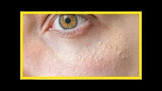 6 techniques naturelles pour retirer les grains de milium autour des yeux [upl. by Dawson]