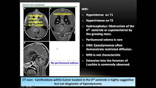 Pediatric Ependymoma Genetics Molecular Classifications and Role of RadiationDr Tanweer Shahid [upl. by Whyte865]