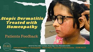 Homeopathy cures Atopic Dermatitis permanently  होम्योपैथीसे एटोपिक डर्मेटिटिस ठीक हुआ [upl. by Adnilema]