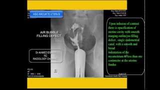 CASE 98 ARCUATE UTERUS [upl. by Bogey]